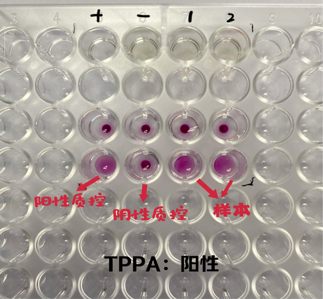 1,梅毒特异性螺旋体血清学试验(tppa)目前应用较广泛的是梅毒血清学
